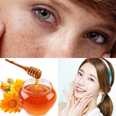 Cách trị nám da mặt hiệu quả bằng mật ong trong vòng 1 tháng