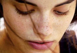 Kem điều trị nám Miami melasma excellent M1 có tốt không?