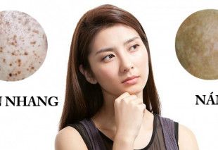 Cách phân biệt giữa tàn nhang và nám