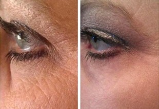 Những ai đã dùng Lycium Serum để Chống lão hóa da, xóa nhăn thâm nám