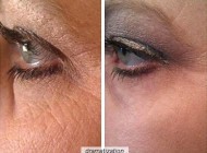 Những ai đã dùng Lycium Serum để Chống lão hóa da, xóa nhăn thâm nám