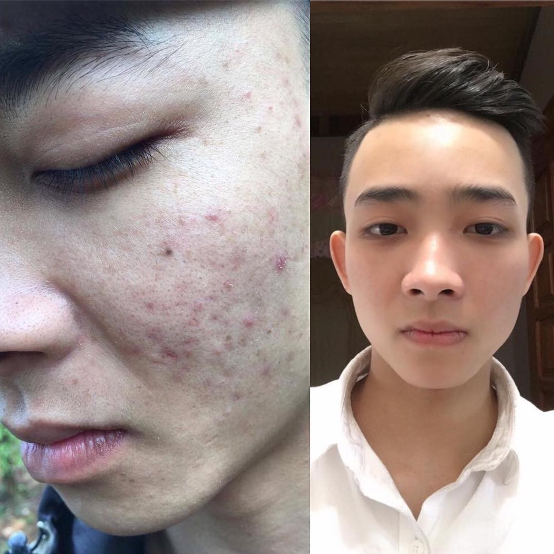 Anh Nguyễn Văn Thắng – 20 tuổi, Tuy Phong, Bình Thuận bị mụn từ khi dậy thì khiến cuộc sống của anh gặp rất nhiều khó khăn