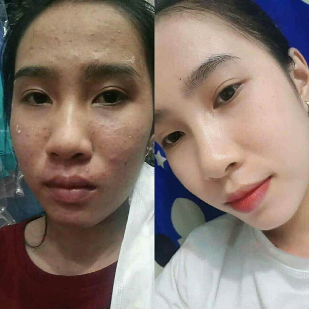 Chị Nguyễn Thị Hoa, 23 tuổi, Thanh Xuân, Hà Nội bị mụn 2 bọc, mụn trứng cá 2 năm. 