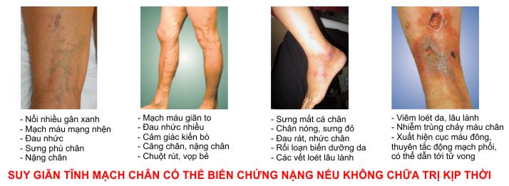 Các biến chứng nguy hiểm của giãn tĩnh mạch chân